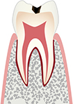 虫歯の進行段階1