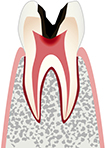 虫歯の進行段階2