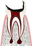 虫歯の進行段階3