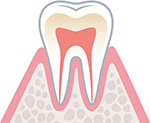 歯周病の進行段階1