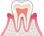 歯周病の進行段階2
