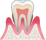 歯周病の進行段階3