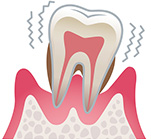 歯周病の進行段階4